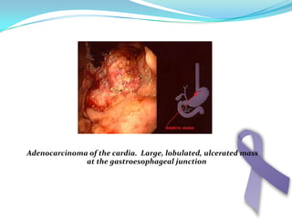 Microscopic picture of adenocarcinomaAmr Mohamed Mosa	735Amr Mohamed Halawa	738