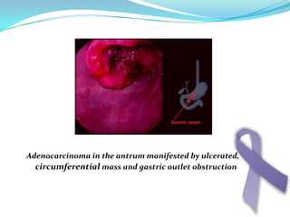 There are a number of classifications proposed forgastric  adenocarcinoma.
