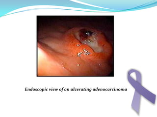 Lauren classification Intestinal typeGlandular cells .(large , abundant cytoplasm , hyperchromic nuclei)Intracellular mucin polarized to surface .Pushed margins , presence of lymphocytes .Metastasizes to nodes, liverDiffuse typeSmall clamps or single .(small . less cytoplasm , hypochromic nuclei)No polarized mucin .Diffuse and infiltrative .Mixtures of above two types