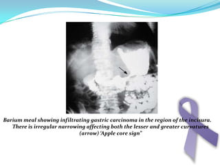 DyspepsiaHighly suspicion for any elderly man above 40 complaining of dyspepsia which does not clear completely under simple medical treatment to stop medication and be investigated for  gastric carcinoma .