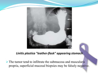 Pain:it differs from that of peptic ulcer that it is not usually induced after meals but more to be induced after meat and protein meals .it is not responsive to medical treatment , vomiting or alkali .it is usually due to high tone of the stomach wall or involving of nerve or peritoneum.It is visceral type of pain , vague , located in upper abdomen specially in epigastric region . N.B In gross picture type 2 and 3 (non infiltrating – infiltrating ulcer) there is peptic ulcer like pain and even relieved by antacid and this is dangerous cause it delay the diagnosis but usually there is achlorhydra .