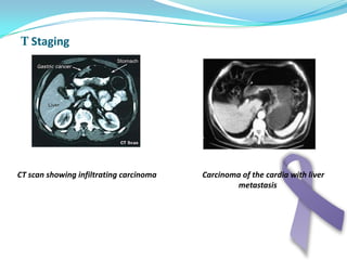 Nausea:Sickness sensation without actual vomit + sweating + feeling to faint .It happen due to hypotonia of gastric musculature , It is usually psychic in origin but as well in organic diseases like carcinoma or chronic gastritis .Nausea usually precede vomiting 