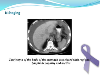 Flatulence:Distention of stomach with gas which usually tend to be belshed but it is more in functional stomach disease more than organic ones .