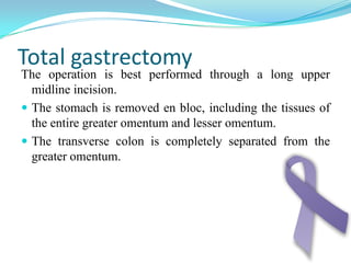 Adenocarcinoma in the antrum manifested by ulcerated, circumferential mass and gastric outlet obstruction