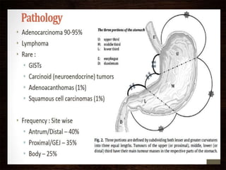 Pathology
• Adenocarcinoma (90-95%)
• Lymphomas (2nd most common)
• Leiomyosarcoma
• Carcinoid
• Adenoacanthomas
• Squamous cell
 