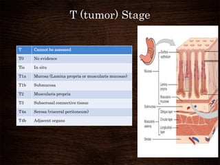 T (tumor) Stage
T Cannot be assessed
T0 No evidence
Tis In situ
T1a Mucosa (Lamina propria or muscularis mucosae)
T1b Submucosa
T2 Muscularis propria
T3 Subserosal connective tissue
T4a Serosa (visceral peritoneum)
T4b Adjacent organs
 