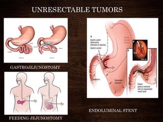 UNRESECTABLE TUMORS
ENDOLUMINAL STENT
GASTROJEJUNOSTOMY
FEEDING JEJUNOSTOMY
 
