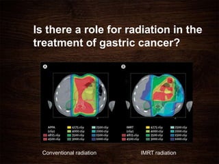 Is there a role for radiation in the
treatment of gastric cancer?
Conventional radiation IMRT radiation
 