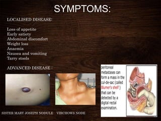 SYMPTOMS:
LOCALISED DISEASE:
Loss of appetite
Early satiety
Abdominal discomfort
Weight loss
Anaemia
Nausea and vomiting
Tarry stools
ADVANCED DISEASE :
SISTER MARY JOSEPH NODULE VIRCHOWS NODE
 