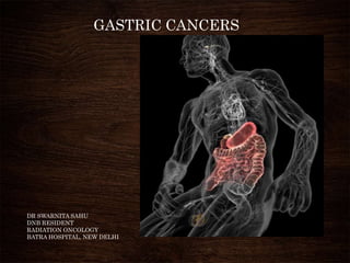 GASTRIC CANCERS
DR SWARNITA SAHU
DNB RESIDENT
RADIATION ONCOLOGY
BATRA HOSPITAL, NEW DELHI
 