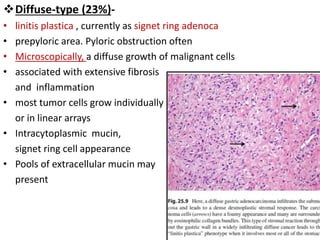 Gastric Cancer - Pathology Seminar | PPT