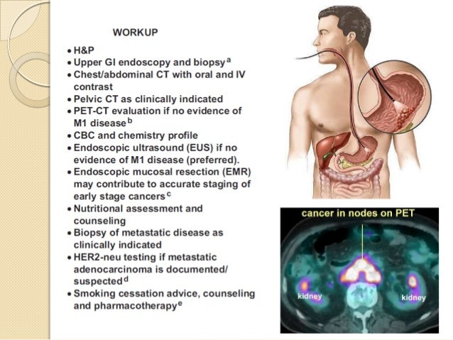 Radiation for stomach cancer