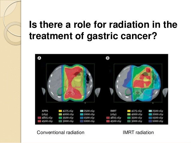 Radiation for Gastric Cancer