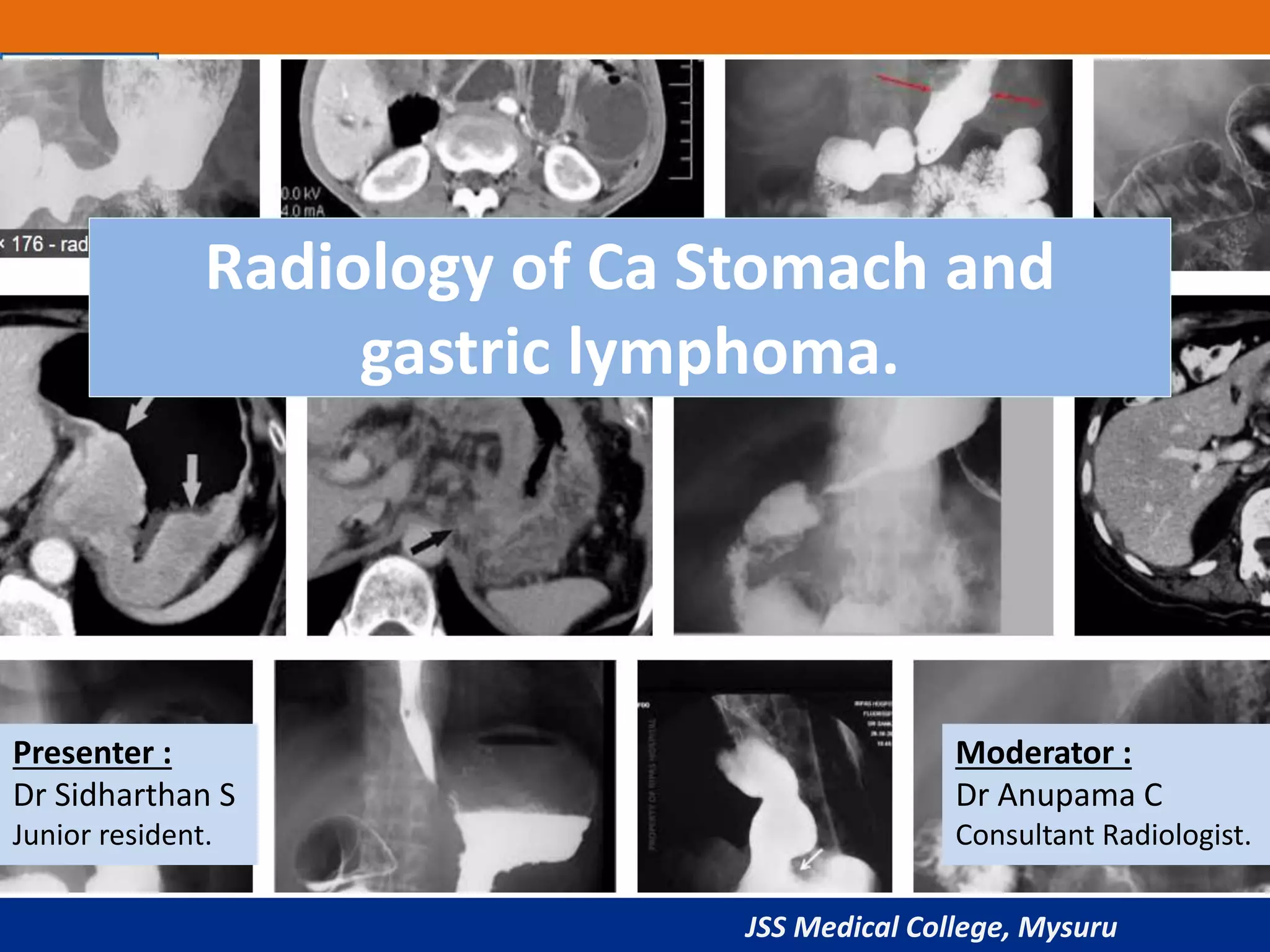 Gastric carcinoma radiology ppt | PPTX