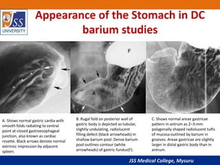 Hampton Line Gastric carcinoma radiology ppt | PPTX
