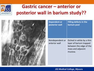 Hampton Line Gastric carcinoma radiology ppt | PPTX