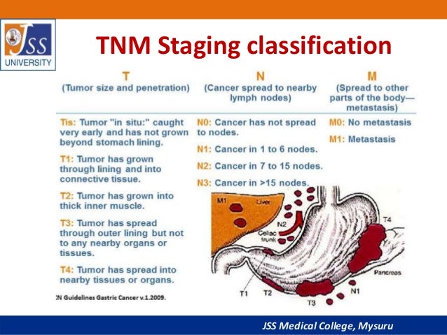 Cancer Staging National Cancer Institute