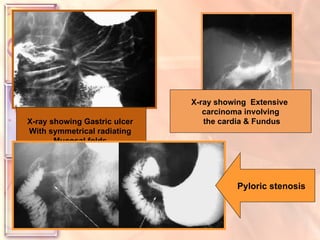 X-ray showing Gastric ulcer  With symmetrical radiating  Mucosal folds. By histology, no evidence of  Malignancies was observed. X-ray showing  Extensive  carcinoma involving the cardia & Fundus Pyloric stenosis 