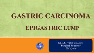 GASTRIC CARCINOMA
EPIGASTRIC LUMP
AN OVRVIEW
Dr.B.Selvaraj MS;Mch;FICS;
“Surgical Educator”
Malaysia
 