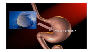 Gastric Disorders Part 1.Hhhhhhhhhtfeefeff