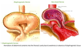 Diaphragmatic Hernia Non-Axial Hernia
• Diaphragmatic hernia:
Herniation of abdominal contents into the thoracic cavity due to weakness or absence of diaphragmatic tissue
 
