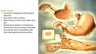 Pyloric Stenosis
Pyloric stenosis
• Concentric enlargement of the pyloric
sphincter
• Seen early in life in infants
• Affects boys 3-4 times more often than
girls
• Multifactorial pattern of inheritance;
familial occurrence has been described
and may be seen in association with
other developmental abnormalities
 