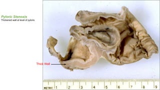 Pyloric Stenosis
Thick Wall
Pyloric Stenosis
Thickened wall at level of pyloris
 