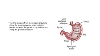 • The line is drawn from the incisura angularis
along the lesser curvature to an indistinct
border between the gastric body and antrum
along the greater curvature
 