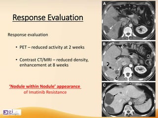 Response Evaluation
Response evaluation
• PET – reduced activity at 2 weeks
• Contrast CT/MRI – reduced density,
enhancement at 8 weeks
‘Nodule within Nodule’ appearance
of Imatinib Resistance
 