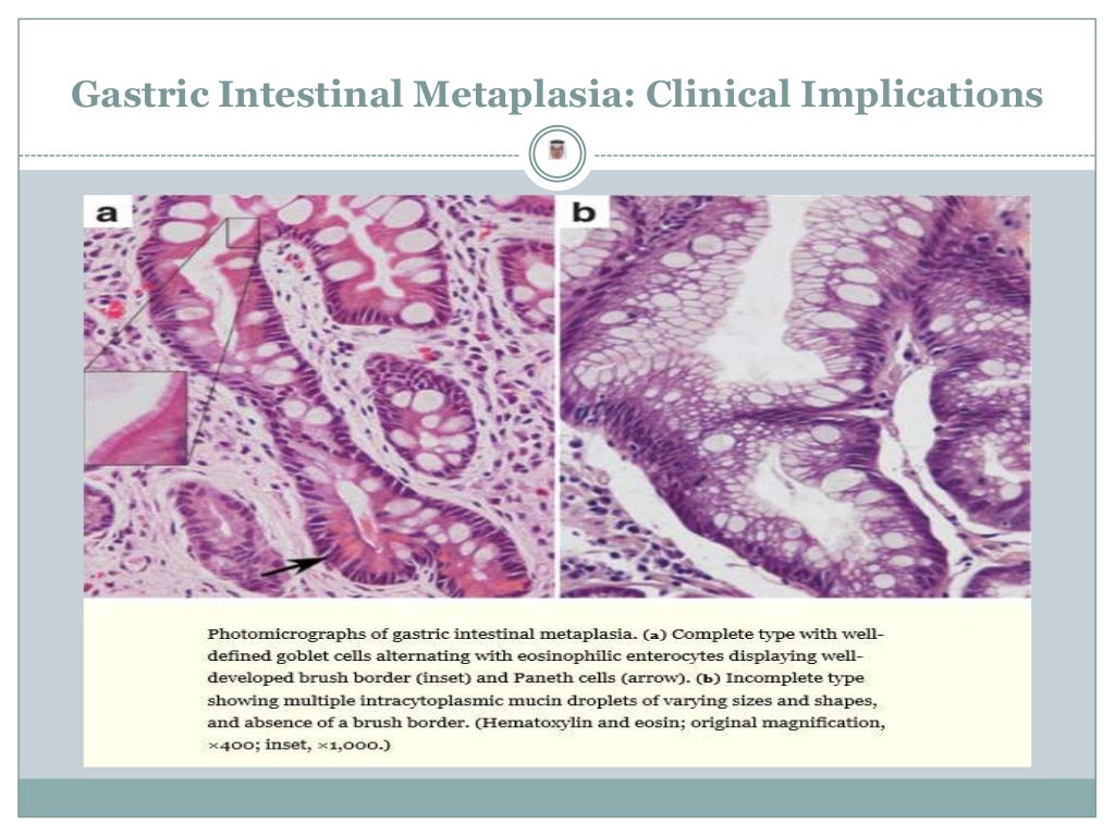 Metaplasia In The Stomach—Precursor Of Gastric Cancer? – PNSWG