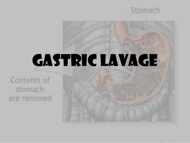 gastric lavage gavage feeding
