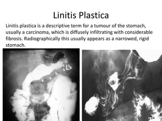 Lenitis Gastric neoplasm | PPTX