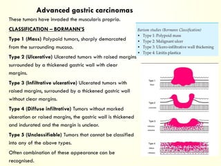 Boreman Classification Imaging of Benign and Malignant Gastric Neoplasms | PPTX