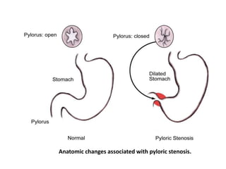 Anatomic changes associated with pyloric stenosis. 
 