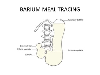 BARIUM MEAL TRACING 
 