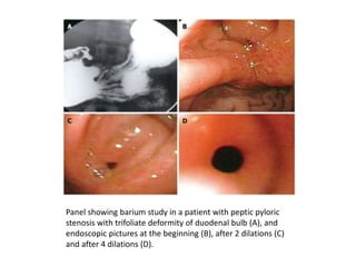 Panel showing barium study in a patient with peptic pyloric 
stenosis with trifoliate deformity of duodenal bulb (A), and 
endoscopic pictures at the beginning (B), after 2 dilations (C) 
and after 4 dilations (D). 
 