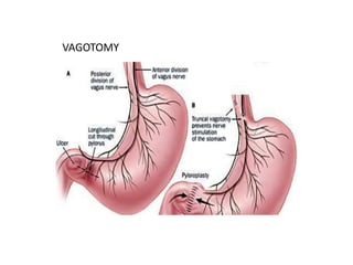 VAGOTOMY 
 