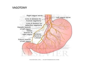 VAGOTOMY 
 
