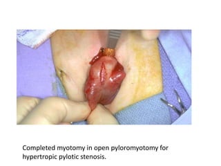 Completed myotomy in open pyloromyotomy for 
hypertropic pylotic stenosis. 
 