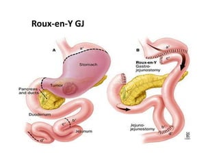 Roux-en-Y GJ 
 