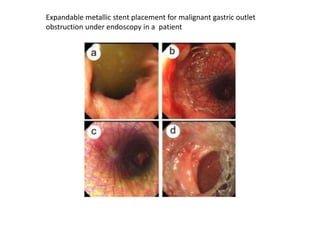Expandable metallic stent placement for malignant gastric outlet 
obstruction under endoscopy in a patient 
 