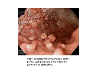 Upper endoscopy showing multiple gastric 
polyps. Such polyps are a major cause of 
gastric outlet obstruction. 
 