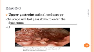 IMAGING
 Upper gastrointestinal endoscopy
-the scope will fail pass down to enter the
duodenum
-a biopsy may be taken during the procedure
10/17/2019
29
 