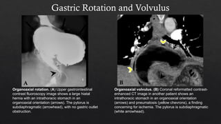 Stomach Rotation Radiology gastric pathology and how they present radiologically | PPTX