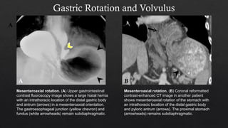 Stomach Rotation Radiology gastric pathology and how they present radiologically | PPTX
