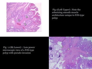 Arborizing Polyps Gastric polyps & tumors by Dr. Karan Arora | PPTX