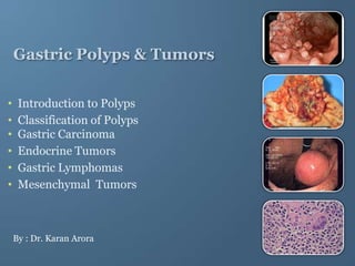 Gastric Polyps & Tumors


•    Introduction to Polyps
•    Classification of Polyps
•    Gastric Carcinoma
•    Endocrine Tumors
•    Gastric Lymphomas
•    Mesenchymal Tumors



    By : Dr. Karan Arora
 