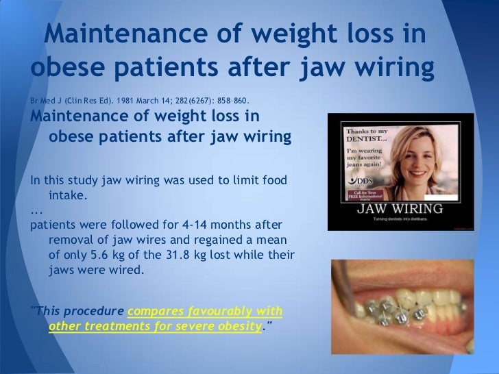 Jaw Wiring For Weight Loss Cost In South Africa WeightLossLook