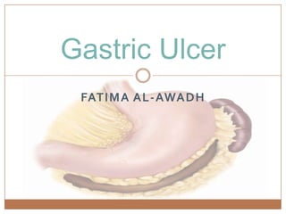 Gastric Ulcer
 FATIMA AL-AWADH
 