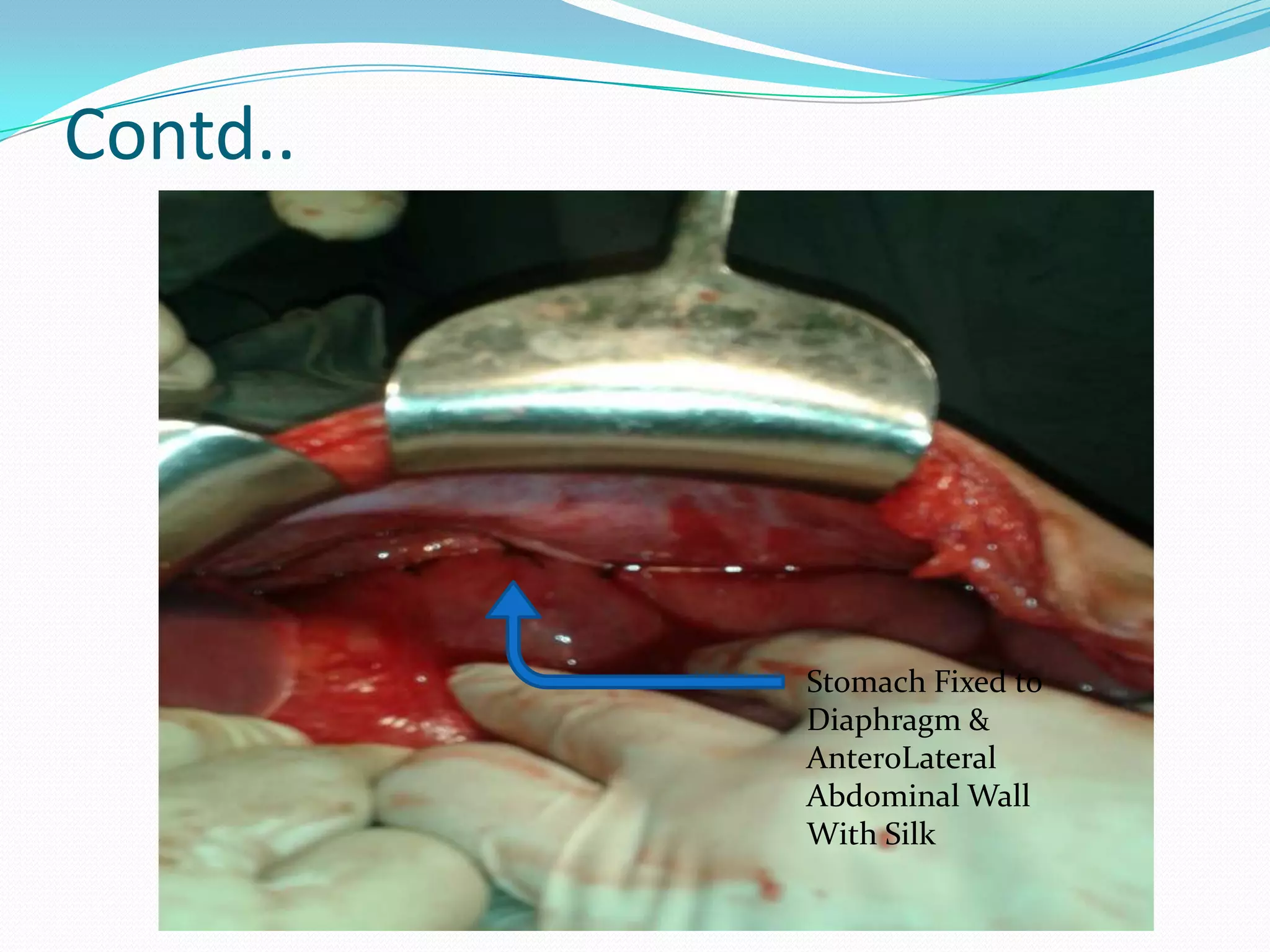 Contd..

Stomach Fixed to
Diaphragm &
AnteroLateral
Abdominal Wall
With Silk

 